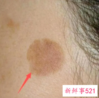 脸上老人斑的比较好消除方法