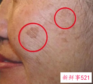 脸上老人斑的比较好消除方法
