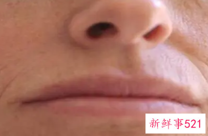 如何预防嘴周围皱纹