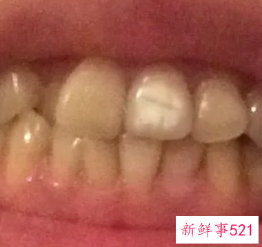10岁儿童大门牙有白斑