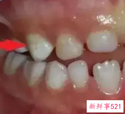 10岁儿童大门牙有白斑