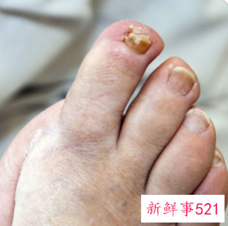 脚两边很痒是什么原因