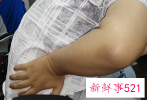 腰间盘突出有哪些症状