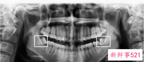 怎么看自己有没有智齿