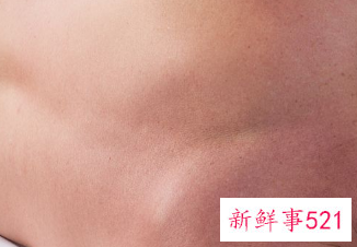 脖纹怎么快速消除