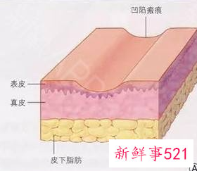 脂肪填充一年后后遗症