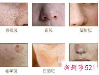 黄褐斑和晒斑的区别在哪里