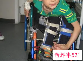 儿童脑瘫治疗方法