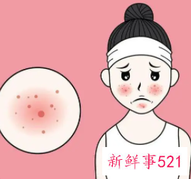 有什么办法淡化痘印