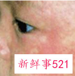 儿童皮肤病图片