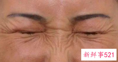 女性各年龄段出现的面部皱纹