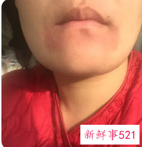 下巴发红不痛不痒怎么回事