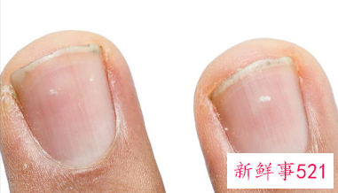 指甲上有黑色的小竖线