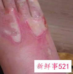 烫伤皮掉了肉红红的会留疤吗