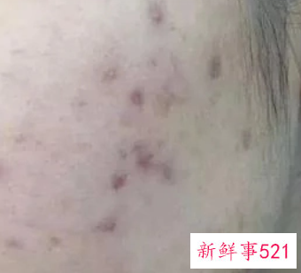 黑色痘印和红色痘印的区别