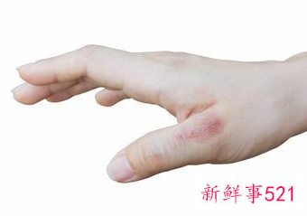 孕妇烫伤可以涂芦荟胶吗