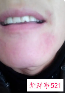 下巴发红不痛不痒怎么回事