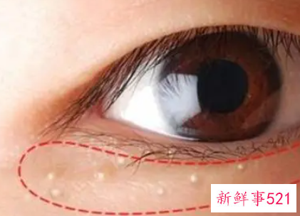眼角起脂肪粒什么原因