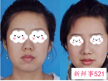 做鼻子要定期修复吗