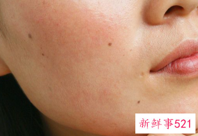 脸上脱皮发红发痒紧绷