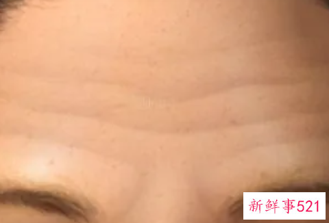 用什么方法去额头纹