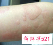 儿童皮肤病图片