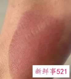 烫伤皮掉了肉红红的会留疤吗