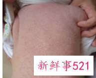 儿童皮肤病图片