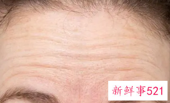 额头出现细纹按摩可以消除吗