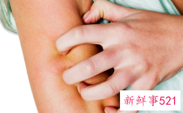 皮肤瘙痒警惕4种癌症