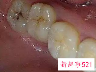 怎么看自己有没有智齿