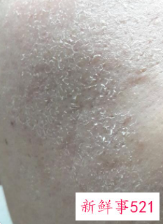 脸上脱皮发红发痒紧绷