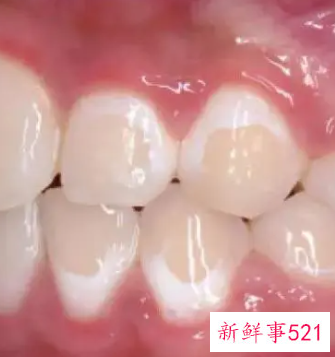 10岁儿童大门牙有白斑