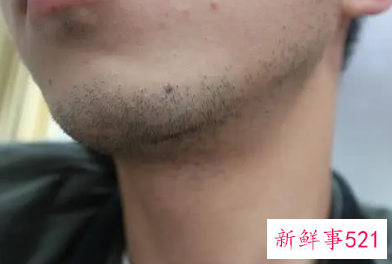 男士的脸两边的胡子怎样永久去除