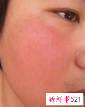 脸发热发红发痒怎么快速缓解