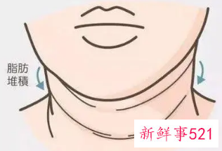 脖纹怎么快速消除