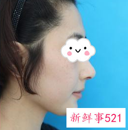 做鼻子要定期修复吗