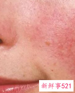 脸发热发红发痒怎么快速缓解