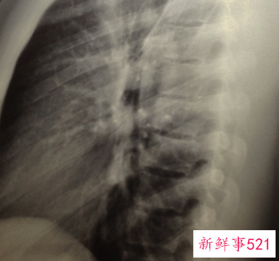 常照X光会诱发荨麻疹