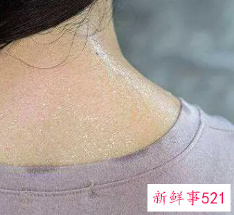 为什么出汗后皮肤会变白