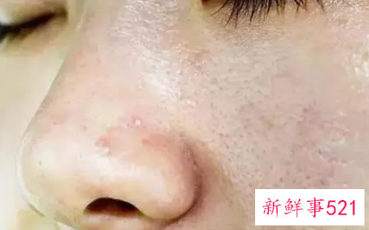 女性身体油脂分泌旺盛怎么办