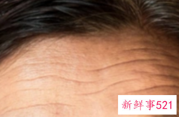 额头出现细纹按摩可以消除吗