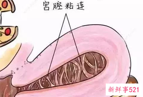 宫腔粘连b超能看出来吗