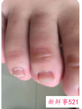 脚两边很痒是什么原因