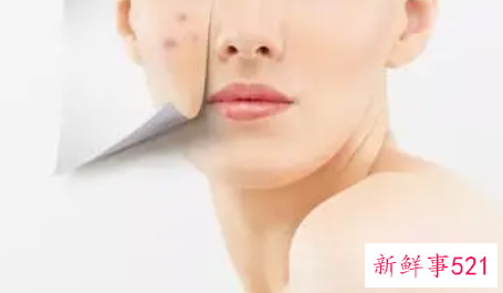 油性皮肤痘痘肌怎么调理