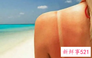 皮肤晒伤后奇痒无比