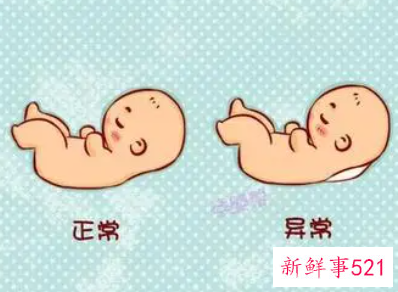 唐氏综合症产前筛查是什么