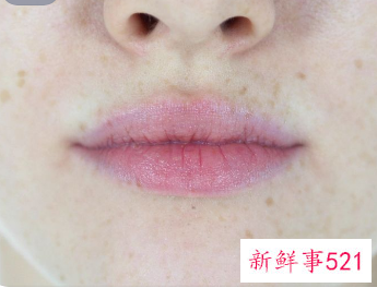 脸上起满了小米粒一样的疙瘩