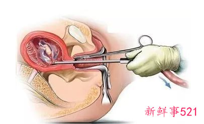 宫腔粘连b超能看出来吗