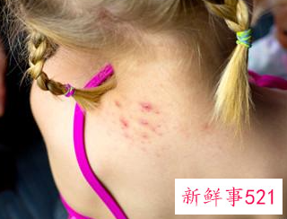 儿童皮肤病图片